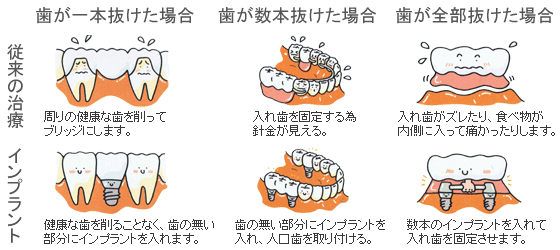 インプラント治療と従来の治療法との違い