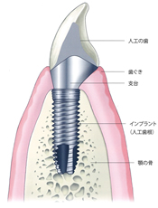 インプラント断面図