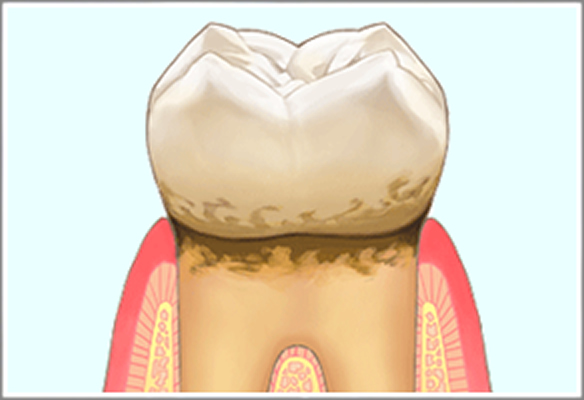 歯周病