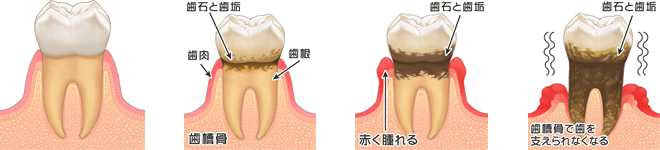 歯周病の進行