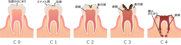 虫歯の進行