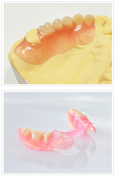 金属バネの無い入れ歯（ノンクラスプデンチャー）