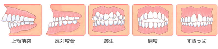歯並びの相談