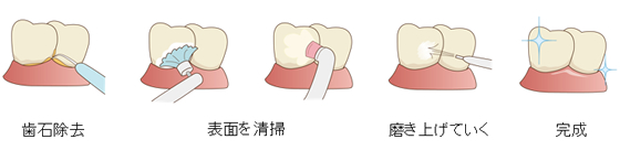 歯のクリーニング